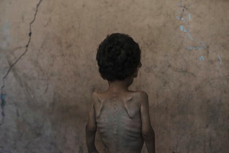 Yazan Abu Ful, a two-year-old malnourished child, poses at his family home in the Shati refugee camp in Gaza City on Wednesday, July 23, 2025.