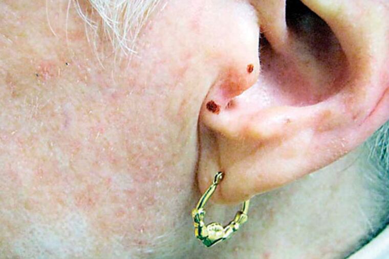 Mohs surgery on Christine McDonnel’s ear to remove a squamous cell cancer. The surgery was done on Dec 30 by Fox Chase dermatologist Clifford Perlis. Source: Fox Chase Cancer Center