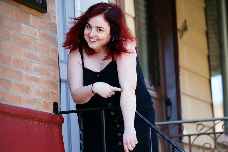 Rachel Sophia Stewart, 28, of South Philadelphia points to her arm with a needle mark after donating her bone marrow for a male cancer victim.