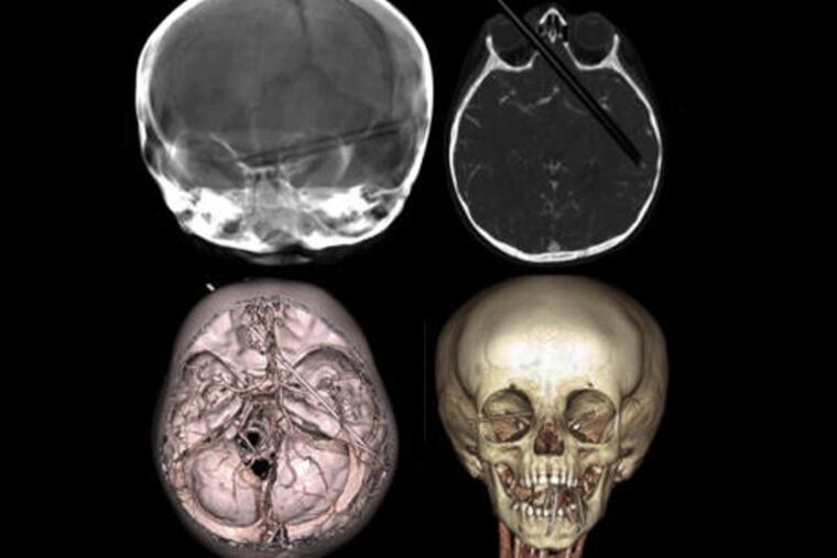 20-month-old Olivia Smith's scans after a colored pencils entered her right eye socket, crossed through her brain and lodged itself there.