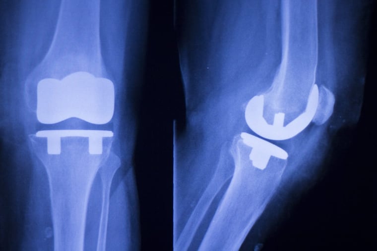 X-rays of a knee replacement.