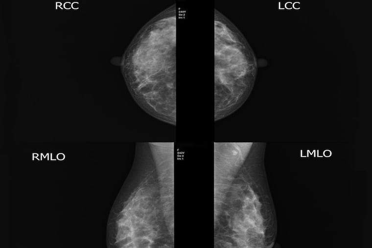 Michelle Smith, who has a family history of breast cancer, got a breast MRI.