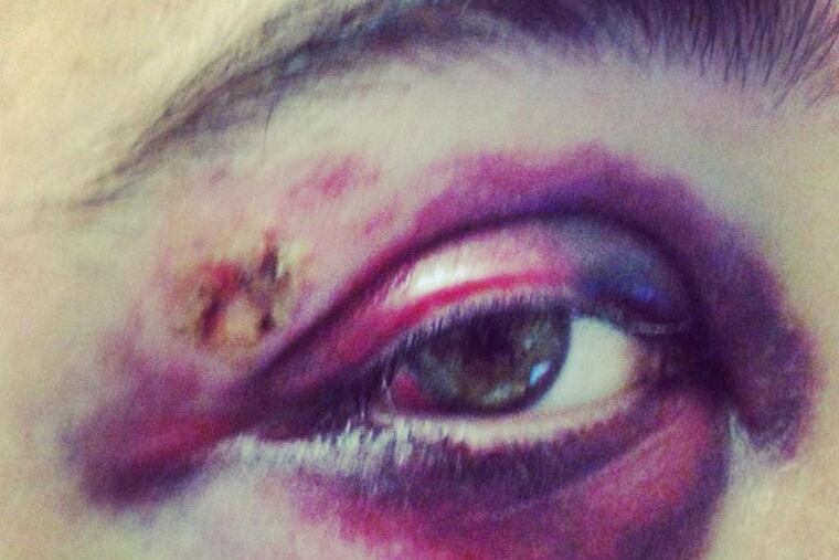 This South Philly man, whose name the Daily News is withholding at his request, was savagely beaten by a group of people, who allegedly yelled homophobic slurs during their attack. As a result of the violence late Thursday, the man’s orbital bone was fractured, and his jaw must stay wired shut for eight weeks. (Courtesy of Caryn Kunkle)