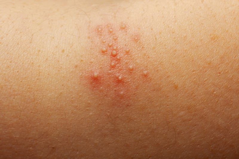 Realistic Heat Rash Q&A: What causes heat rash? | Expert Opinion