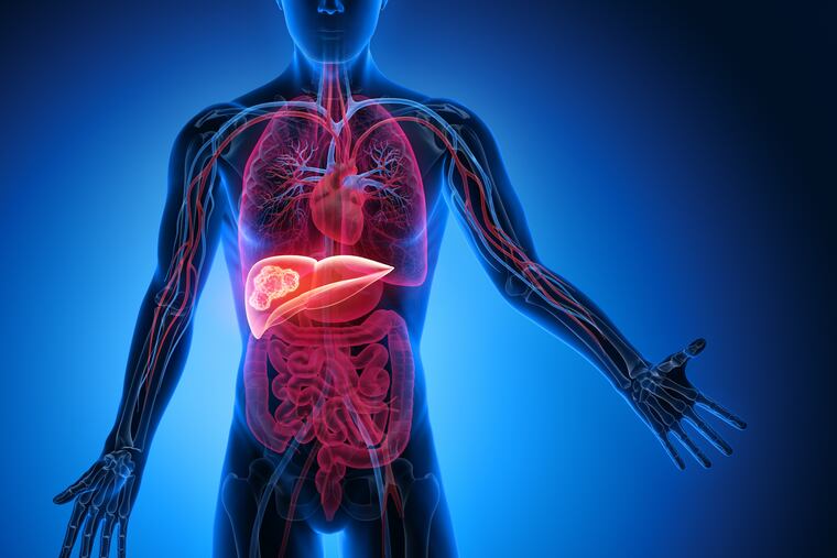 Immunotherapy is a recent advance in treating inoperable liver cancer, but its effectiveness may depend on the origins of the liver damage.