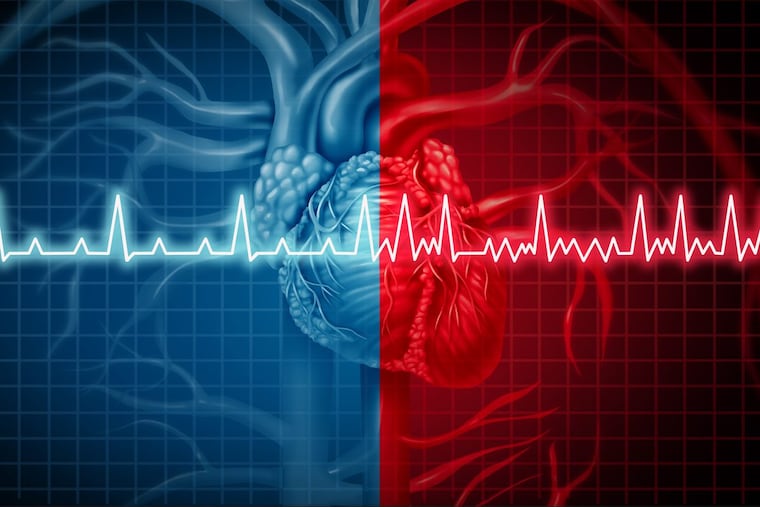 An illustration of Atrial fibrillation.