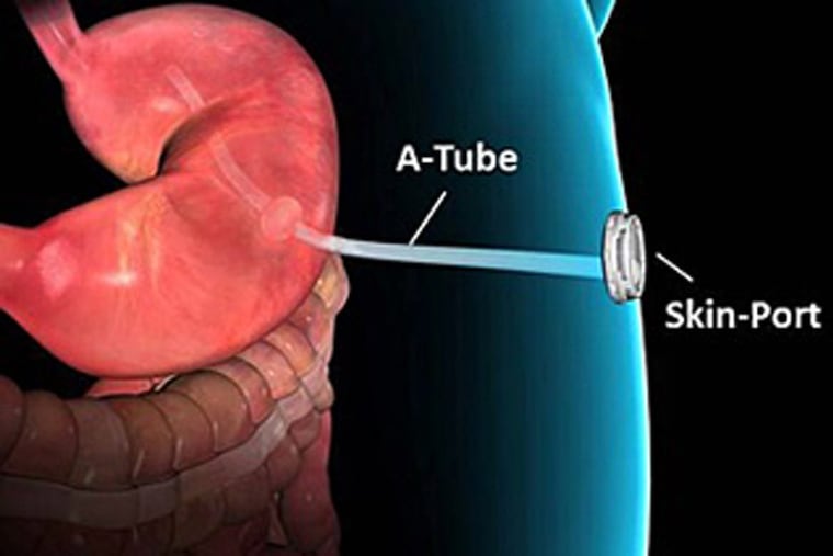 The AspireAssist helps obese patients lose weight by draining a portion of the stomach contents after meals.