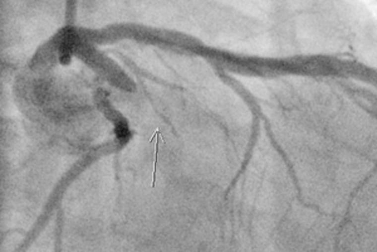 An X-ray view of a blocked heart artery before an emergency stent procedure at Chester County Hospital yesterday.