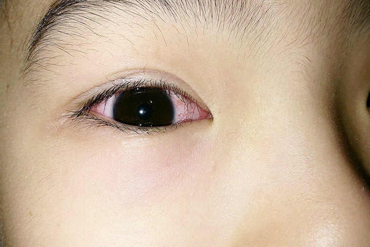 Close-up image of pink-eye, or conjunctivitis.