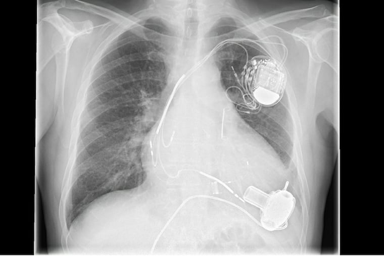 A pacemaker is shown in a chest x-ray.