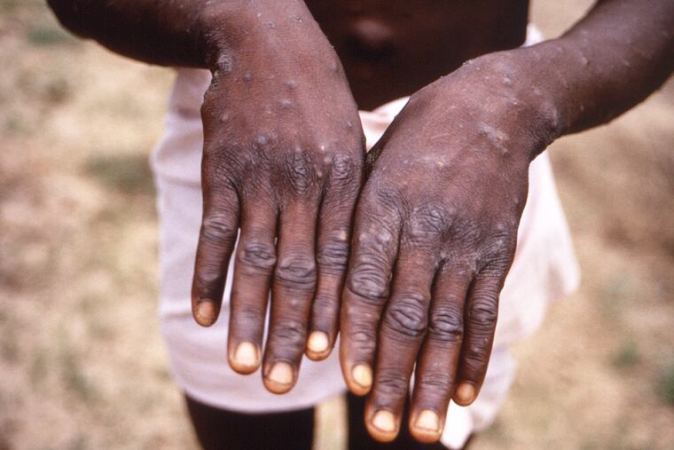FILE - This 1997 image provided by the CDC during an investigation into an outbreak of monkeypox, which took place in the Democratic Republic of the Congo (DRC), formerly Zaire, and depicts the dorsal surfaces of the hands of a monkeypox case patient, who was displaying the appearance of the characteristic rash during its recuperative stage. The World Health Organization is convening its emergency committee on Thursday, July 21, 2022 to consider for the second time within weeks whether the expanding outbreak of monkeypox should be declared a global crisis.
