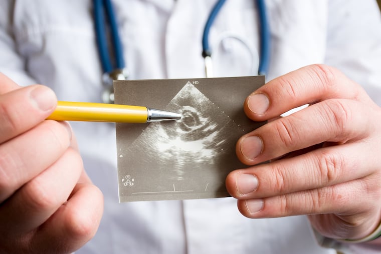 Doctor holds snapshot of a heart ultrasound suggesting a diseased aortic valve.