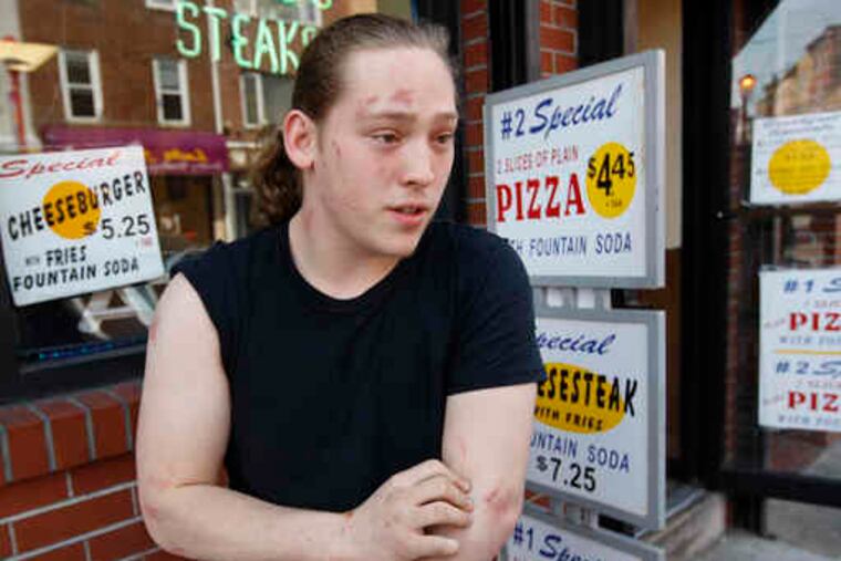 Seth Kaufman, 20, deliveryman for Olympia II Pizza on South Street, shows the scrapes and bruises he received while trying to control a fight in the restaurant and keep it from escalating.