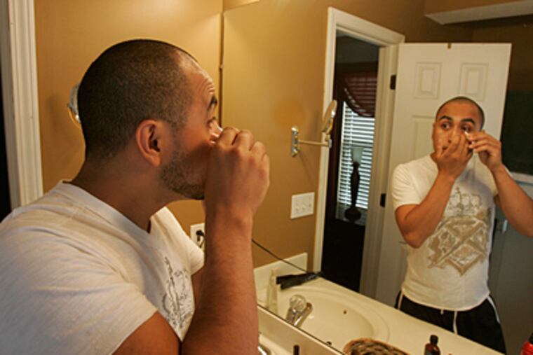 Every two hours, Jose Vega uses ointment to help his right eye, lined with two rows of stitches, heal from surgery. (Jim Barcus/Kansas City Star/MCT