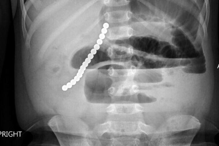 An X-ray of a 2-year-old boy with 16 magnets in his intestines. Critics say magnet companies' calls for voluntary safety standards won't protect children.