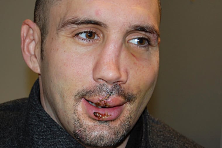 The Flyers' Ian Laperriere lost seven teeth, broke a bone and had close to 100 stitches. (Zack Hill / For the Inquirer)