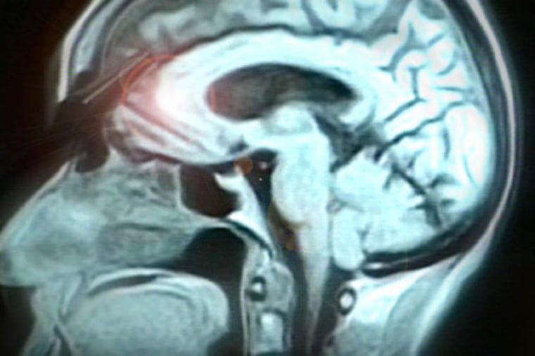 Meningiomas are tumors that develop from the covering of the brain – the meninges.