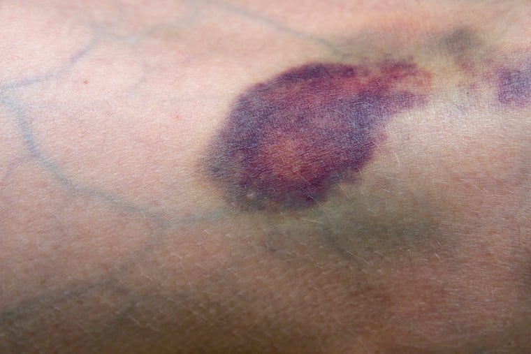 A 62-year-old man had a bruise on his leg that wouldn’t go away for months.