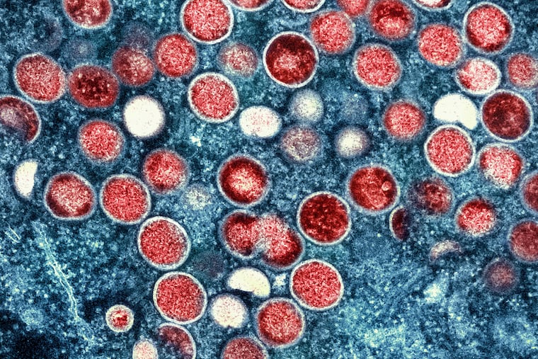 A color-enhanced image of monkeypox particles and infected cells.