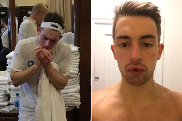 An opponent’s backswing knocked out the front teeth of Tom Billings during the U.S. Open semifinals of a squash-like racket sport called racquets, played in Philadelphia in March. A nearby dentist and maxillofacial surgeon came to his rescue, and he was back on the court two hours later, with lip sutured and teeth glued in place.