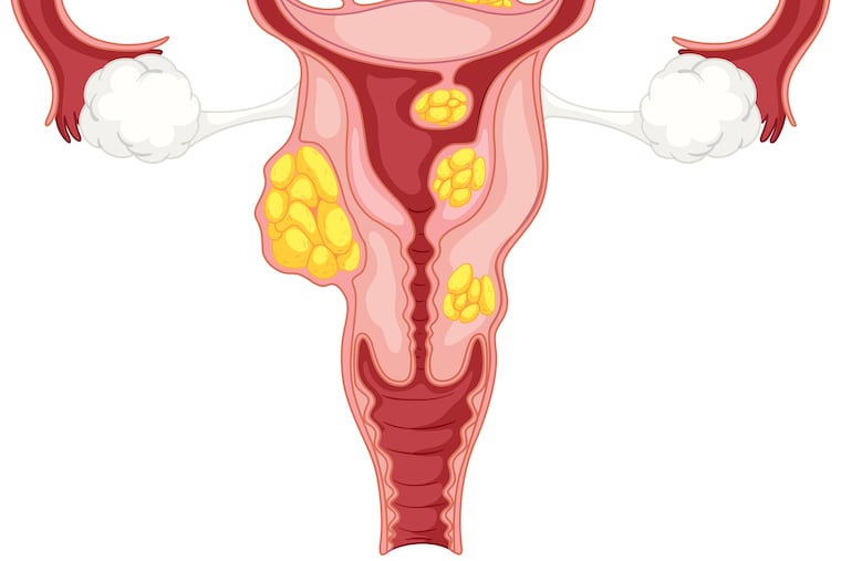 A number of factors can affect your likelihood of getting uterine fibroids.