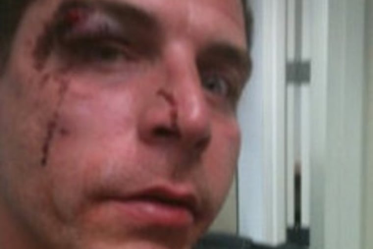 Anthony Flora, 36, said he was the victim of an unprovoked attack at the hands of security guards at Harrah's Atlantic City. He took this selfie soon after the alleged assault.
