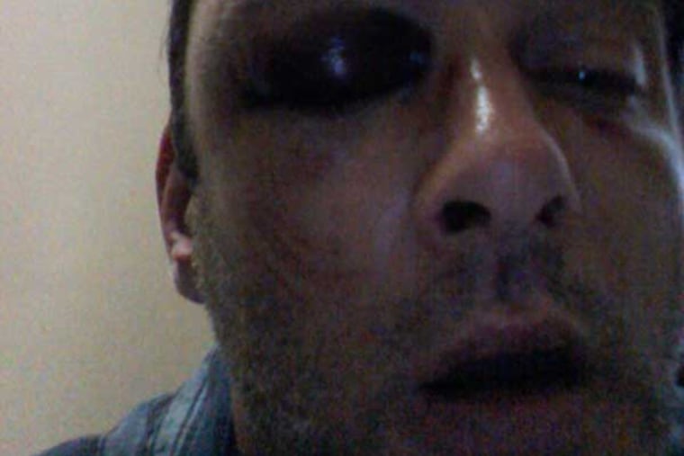 Dan Contarino, formerly of Philadelphia, was beaten in New York City. Police there have charged his attacker with a hate crime in what's being described as a gay-bashing incident.