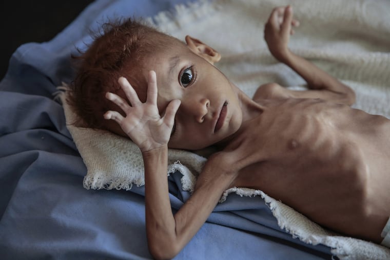 A severely malnourished boy rests on a hospital bed at the Aslam Health Center, Hajjah, Yemen., last month. Malnutrition, cholera, and other epidemic diseases like diphtheria ravaged through the displaced and the impoverished communities ravaged by the Saudi-run, U.S.-backed war.