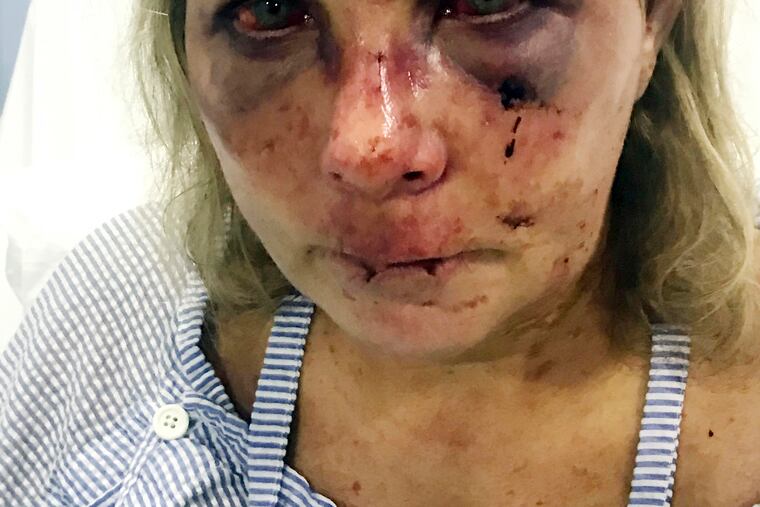In this undated photo made available by Chris Daley, shows his wife Tammy Lawrence-Daley after an attack at a resort in Punta Cana, Dominican Republic in January 2019. Lawrence-Daley made the attack public on social media, detailing a vicious hours-long assault by a man she said was wearing the uniform of an all-inclusive resort.