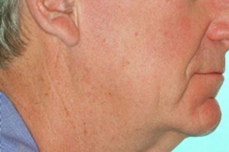 HE1neck28-a - This is a photo of Boston resident Walter Dowgiallo before he had neck surgery.
Source: Dr. Joel J. Feldman