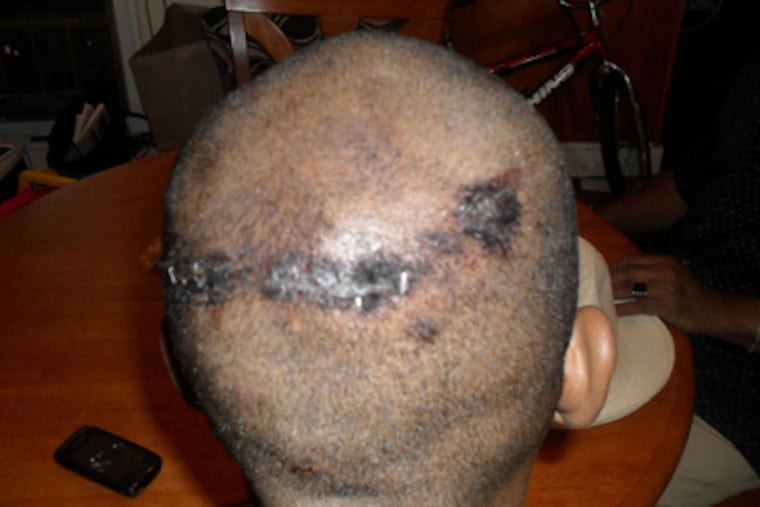 Askia Sabur, who received six staples on his head after an incident with police. (Courtesy of attorney Evan Hughes)