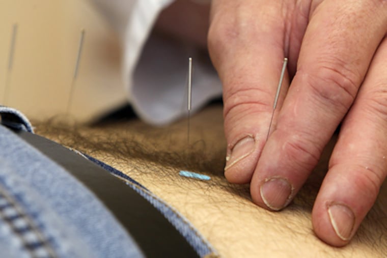 Acupuncture needles are inserted by Ed Cunningham into the back of his son, Samuel Cunningham. Written records of acupuncture go back to 200 B.C. (Akira Suwa / Staff Photographer)