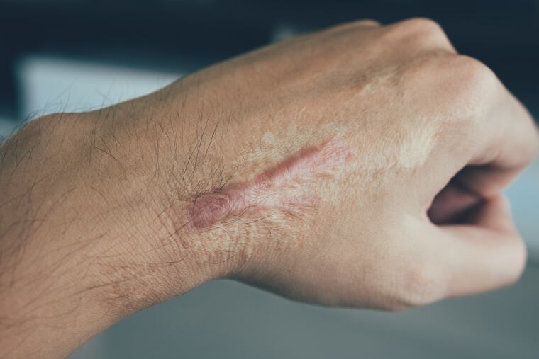 Scar tissue formation involves the building of collagen to reconnect the skin.