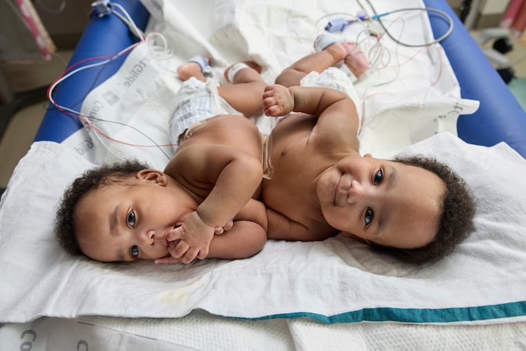 Conjoined twins, Amari and Javar Ruffin, at the Children’s Hospital of Philadelphia on March 20, 2024.