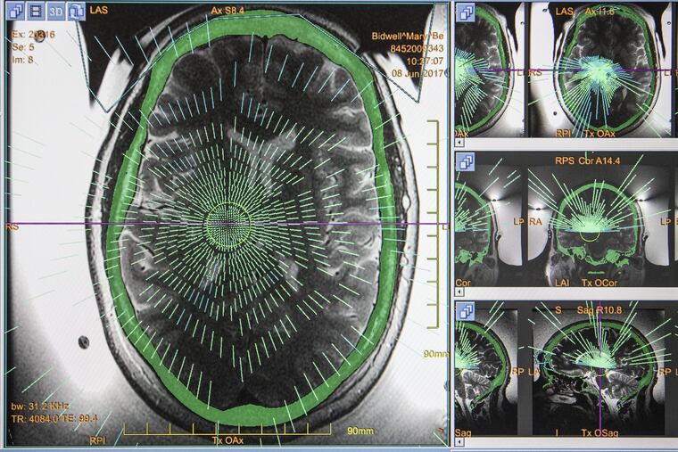 FILE: An MRI scan of a brain that shows the tracer lines of hundreds of tranducers located where essential tremors originate.