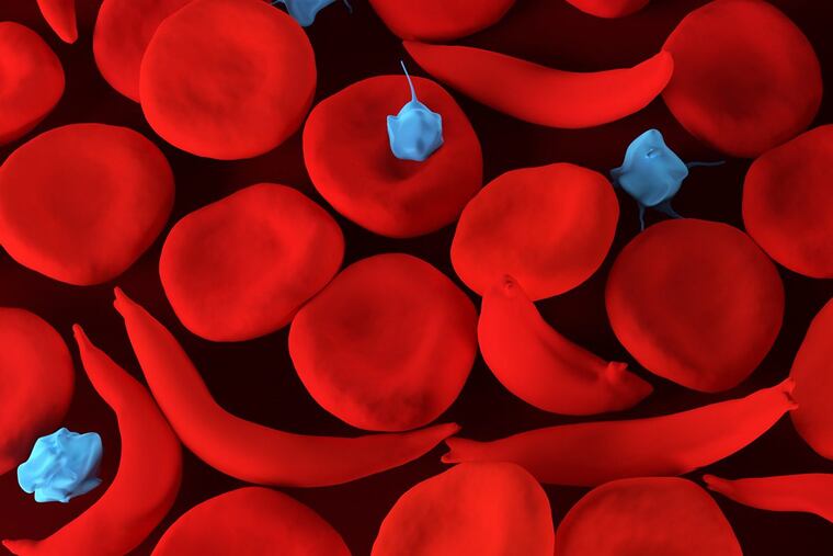 Sickle cell disease causes red blood cells to be abnormally shaped and get stuck inside the blood vessels.
