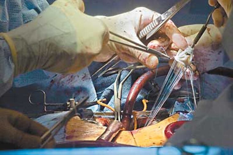 Dr. Paul Addonizio puts a suture through an aortic valve replacement, which will be put into the heart of patient Mark Christopher. (Clem Murray / Inquirer)