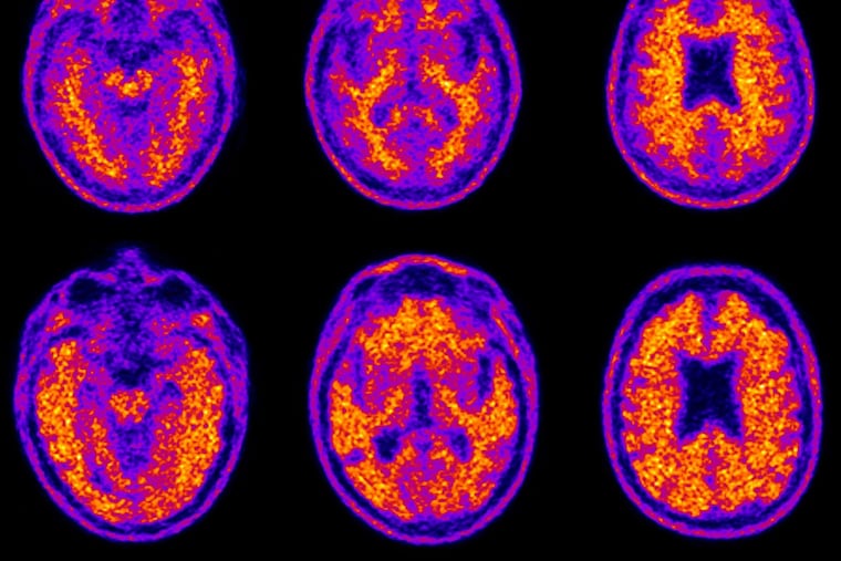 Scans of two participants in a study show the brain of a cognitively healthy 74-year-old (top row) with average financial skills compared to an 86-year-old with mild Alzheimer's disease (bottom row).