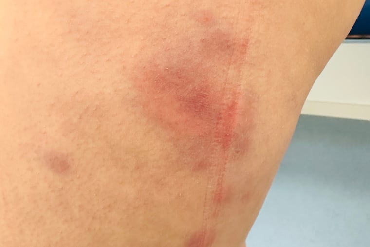 In addition to swelling, a rash like this one formed on a teen patient's legs.