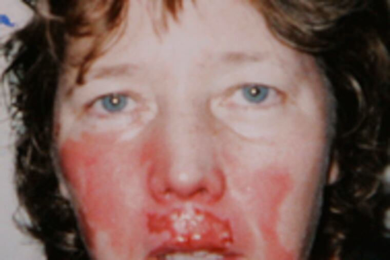 Kathleen Osberger was burned by a fire during surgery. Some blame excessivelypure oxygen for surgical fires.