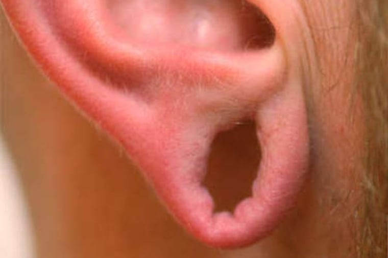 Aaron Storck's lobes had been stretched 1 1/2 inches.