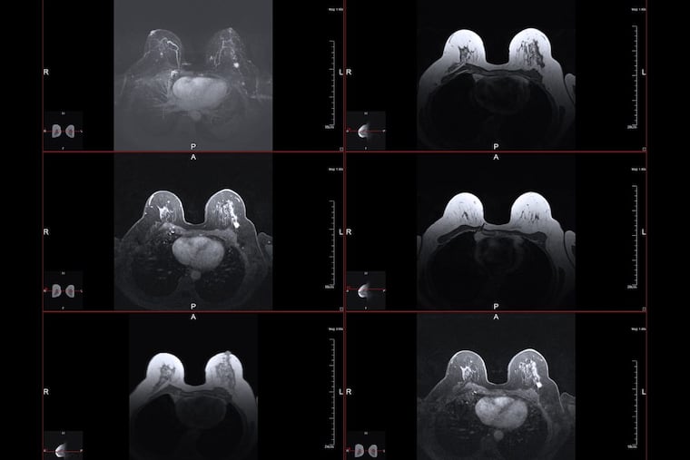 Breast magnetic resonance image.