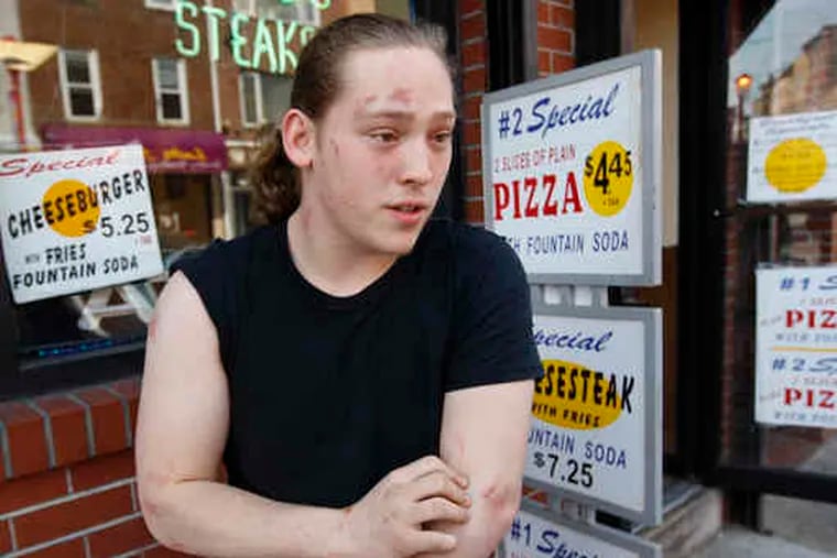 Seth Kaufman, 20, deliveryman for Olympia II Pizza on South Street, shows the scrapes and bruises he received while trying to control a fight in the restaurant and keep it from escalating.