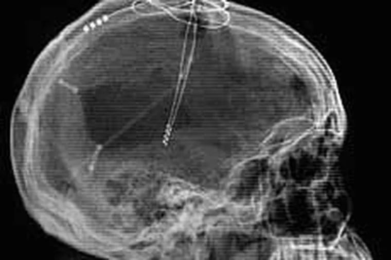 Lateral X-Ray image of the patient showing the deep-brain stimulation leads implanted. (Cleveland Clinic)