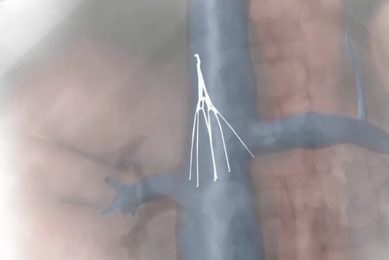 Depiction of the Rex "Option" filter that had been installed inside Tracy Reed-Brown. Reed-Brown was awarded $33.7 million by a Philadelphia jury that found the medical device was defective on Oct. 28, 2019.  (Frame grab from explanatory video by Visual Law Group.)