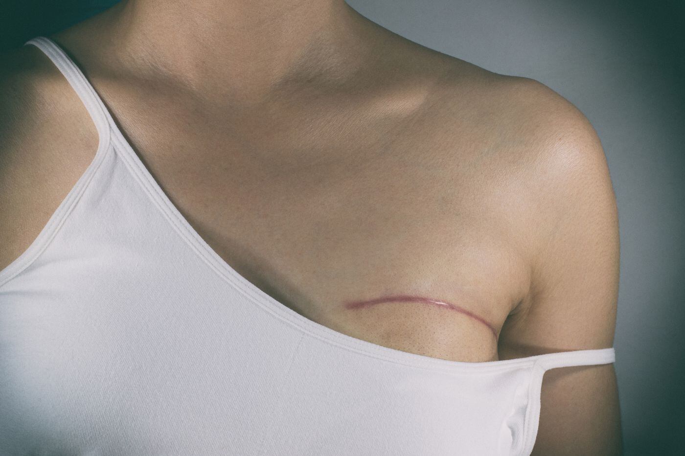 breast reconstruction after a lumpectomy
