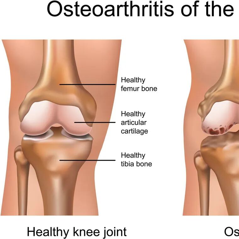 A diagram compares a healthy knee joint to one with osteoarthritis. The Philadelphia Veterans Administration is launching a research center to develop new treatments for the disease.