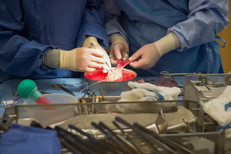 Kidney transplants could be more plentiful — and safe — if U.S. eased age limits, study finds