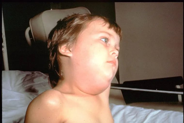 This child exhibits the facial swelling that is a hallmark of the mumps.